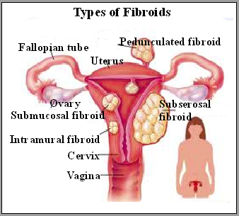 Types of fibroid